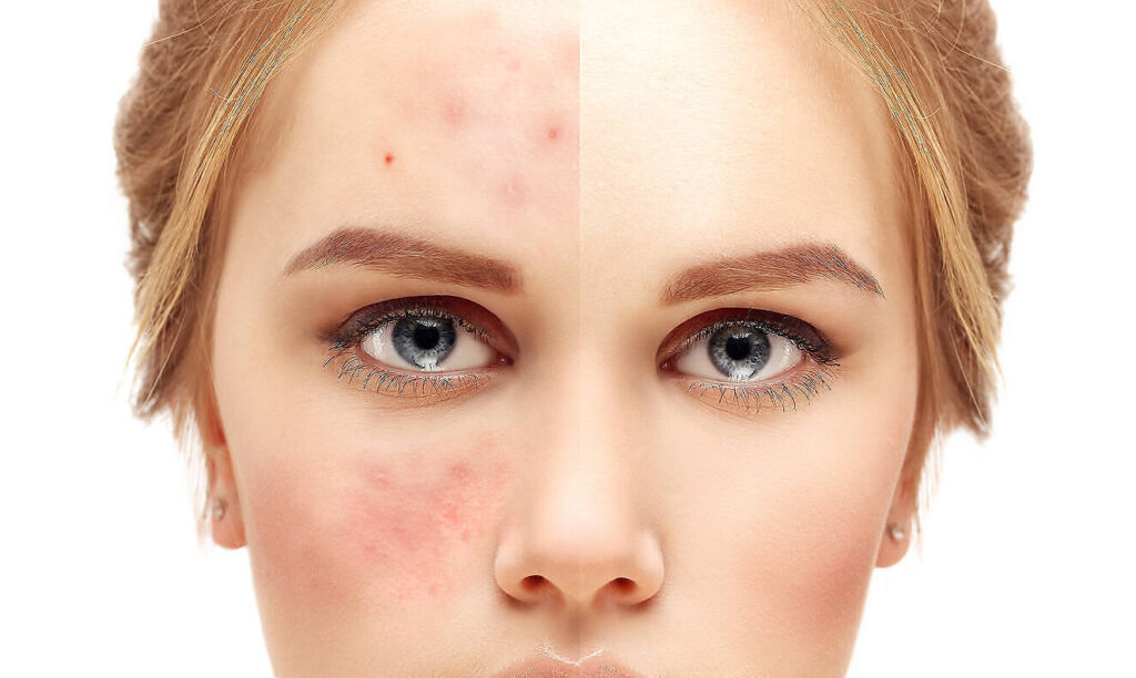 Split-face comparison showing alcohol-induced skin rash and clear skin|a woman with her hands on her face|Close-up of a person's upper arm showing spider veins, a potential sign of alcohol-related skin damage or circulation issues|Close-up of two palms showing reddened, flushed appearance characteristic of palmar erythema, a potential sign of liver issues often associated with alcohol abuse|Close-up of a person's leg showing a psoriasis outbreak with red, scaly patches on the skin, highlighting the connection between physical health and addiction treatment|Close-up of a person's arm showing a red, inflamed skin rash, potentially related to substance abuse or withdrawal symptoms|Close-up image of a red, patchy skin rash likely caused by alcohol consumption, showing inflamed and irritated skin|Close-up of a person's face showing reddened, flushed skin across the cheeks and nose, resembling rosacea, which can be exacerbated by alcohol consumption|Close-up of clasped hands showing dry, reddened skin with possible eczema or dermatitis, which can be exacerbated by alcohol consumption